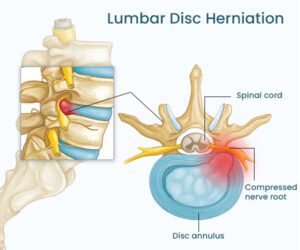 Anatomy-of-Lumbar-Disc-Herniation